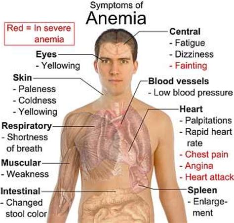 Anaemia: Causes, Symptoms, Foods to Cure Iron Deficiency - HubPages