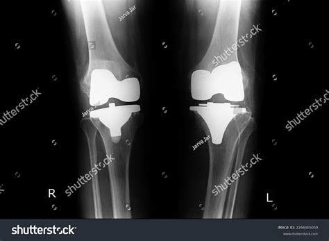 Total Knee Replacement Both Knee Stock Photo 2266005059 | Shutterstock