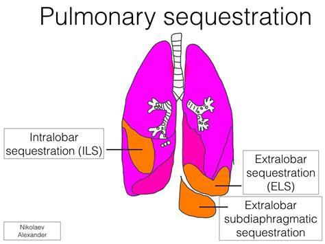 Classification of pulmonary sequestration | Radiology Case ...