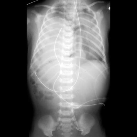 Congenital Diaphragmatic Hernia | Pediatric Radiology Reference Article | Pediatric Imaging ...