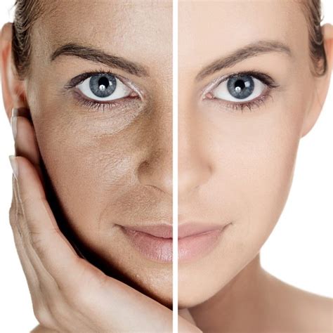 PRP Microneedling Facial Therapy - HealthMedline