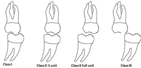 Molar's Classification | Download Scientific Diagram