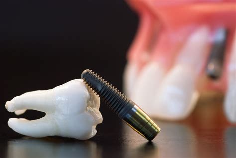 L’implant dentaire, une solution avantageuse | Bücco Orthodontie, par vos orthodontistes