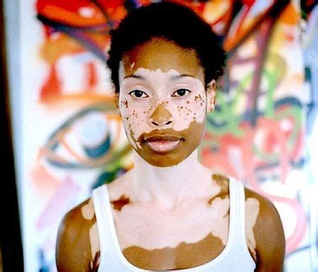 Is It True That Vitiligo Can Be Cured Without Any Medications Or Surgery? | Beauty around the ...