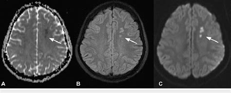 ADC (A), FLAIR (B) and DWI (C) axial sequence in MRI brain showing... | Download Scientific Diagram