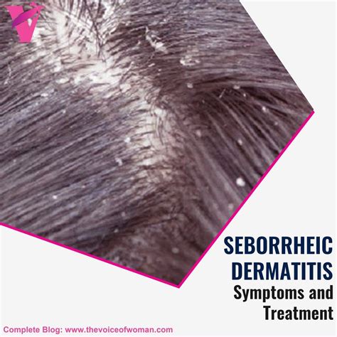 Seborrheic Dermatitis is a skin #disease that causes itchy rashes and ...