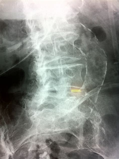 Tortuous Aorta Picture: Pushing The Limits of Human Pathology!