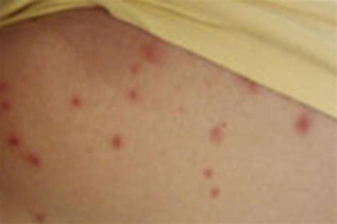 Measles rash - ABC News (Australian Broadcasting Corporation)