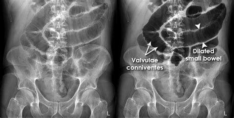 Paralytic Ileus