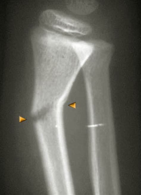 Greenstick Fracture - Pictures, Treatment, Symptoms, Healing Time ...