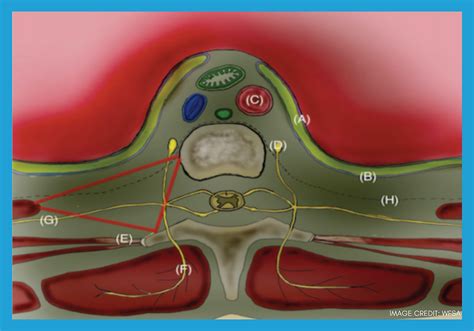 Mastering Technique:Valuable Insights for Paravertebral Block Success