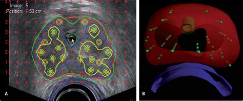 SciELO - Brasil - Long term outcome and side effects in patients ...