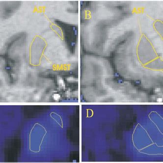 Regions of interest. (A and B) Coronal MRI sections depicting manually... | Download Scientific ...