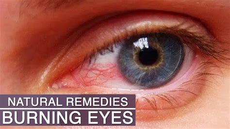 Eye Strain & Burning Eyes Home Remedies | 5 Natural Remedies for Eye Strain, Tired and Burning ...