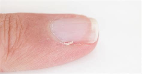 Top 10 Most Common Nail Diseases & Disorders - ProMed Clinic