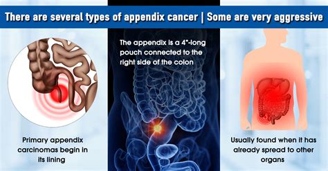 Stages Of Appendix Cancer