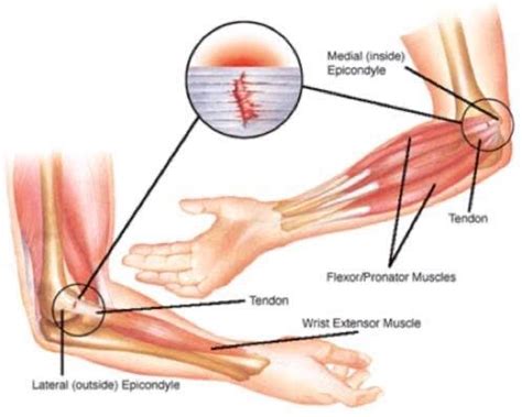 Elbow Pain: 2 Common Conditions and How to fix them - MYO Sports