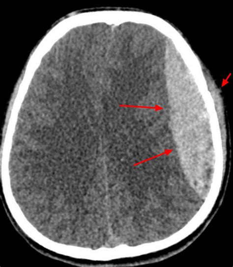 Epidural hematoma causes, signs, symptoms, diagnosis & treatment