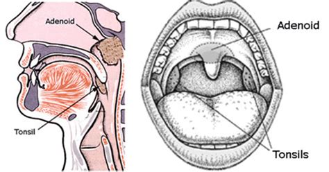 Tonsil Removal - Tonsil and Adenoid Surgery - ENT Clinic