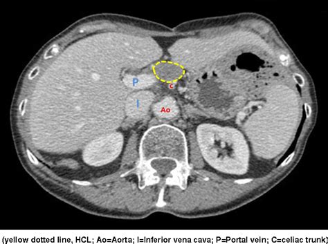 Porta Hepatis Lymph Node