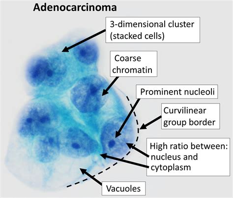 Adenocarcinoma - Wikiwand