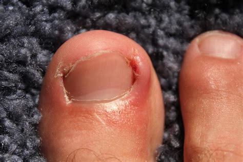 When It’s Time to See a Podiatrist for an Ingrown Toenail: Hubert Lee, DPM: Podiatrist