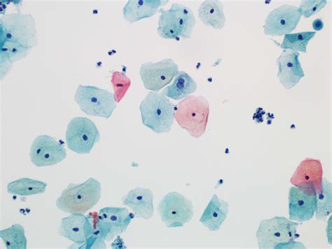 Pathology Outlines - ASCUS (cytology)