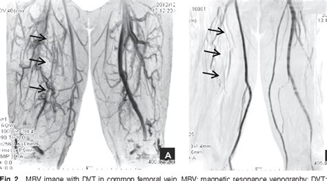 [PDF] MR Venography for the Assessment of Deep Vein Thrombosis in Lower ...