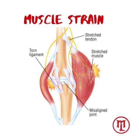 Best Recovery Tips For Healing Muscle Strains – Lee's Fitness Unlimited