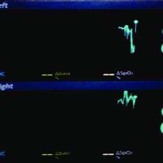 Near-infrared spectroscopy monitor showing regional cerebral... | Download Scientific Diagram