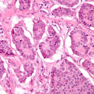 Histopathological appearance of Insulinoma | Download Scientific Diagram