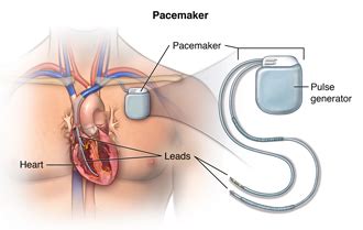 Pacemaker Insertion | Johns Hopkins Medicine