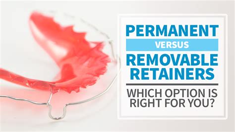 Permanent vs Removable Retainers - Midwest Orthodontics Center Blog