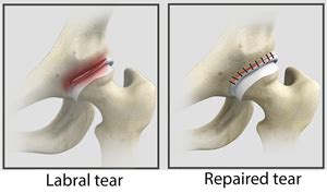 Torn Hip Ligament Surgery