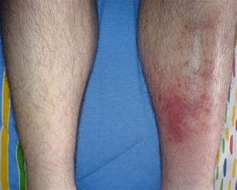 Cellulitis: Treatment, Symptoms, Signs, Causes and Complications - Jotscroll