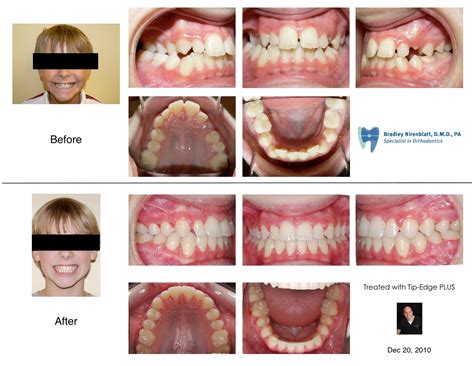 Posterior Crossbite Treated Without An Expander