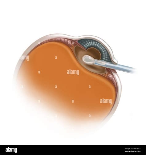 Lens Replacement Surgery Stock Photo - Alamy