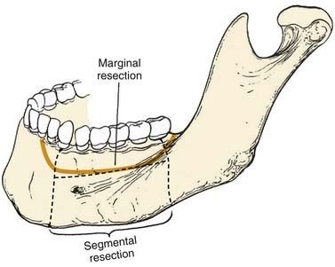 Reconstruction of the Mandible | Ento Key