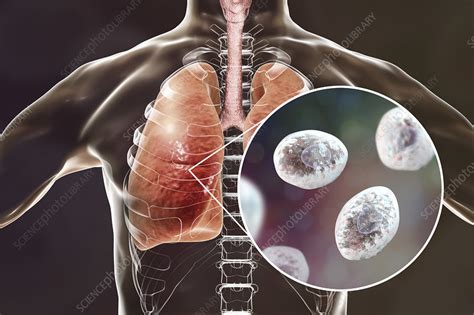 Pneumocystis pneumonia, conceptual illustration - Stock Image - F022/1973 - Science Photo Library