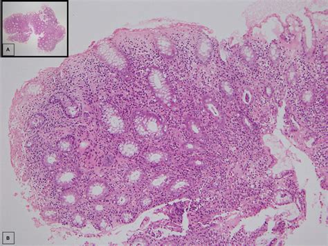 Microscopic findings of sigmoid colon biopsy: in a low-power field (A ...