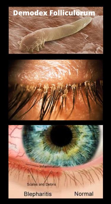 Demodex Blepharitis - Eye Care Solutions