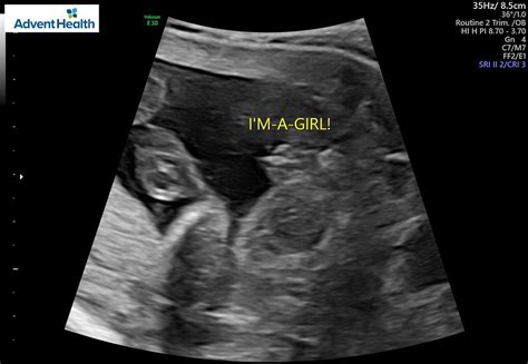 Skeptical it's a girl (20 week ultrasound) | BabyCenter