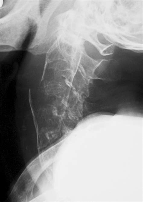 A plain radiograph taken before Halo-vest immobilization shows a ...