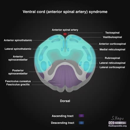 Anterior Cord Syndrome Vertebral Artery