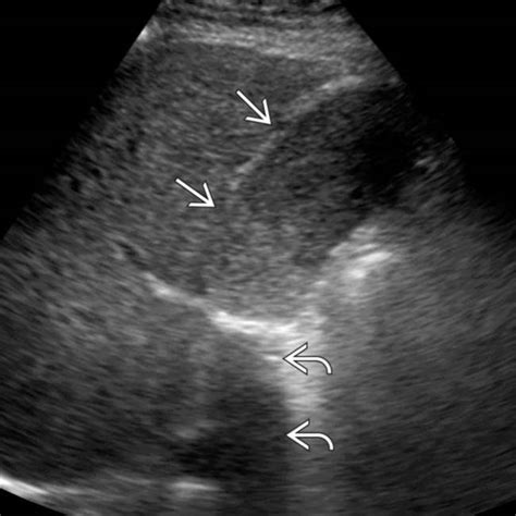 Milk Of Calcium Cyst Ultrasound