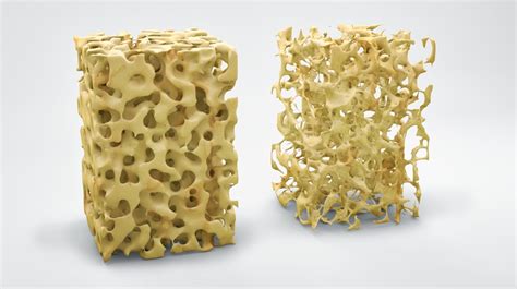 Osteoporosis - Your Health