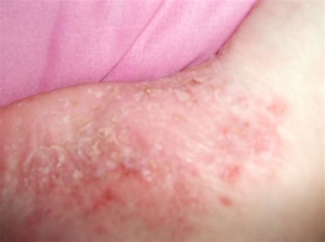 palmoplantar Pustular psoriasis | Pustular psoriasis, Palmoplantar ...