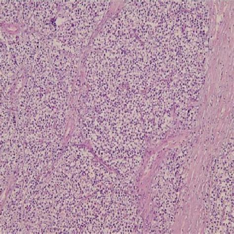 Yolk sac tumor and immature teratoma components. There is alveolar and... | Download Scientific ...