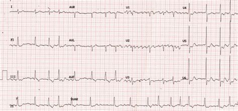 Coarse atrial fibrillation on ECG – All About Cardiovascular System and ...