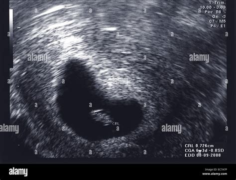 Ultrasound scan of fetus at first trimester Stock Photo - Alamy